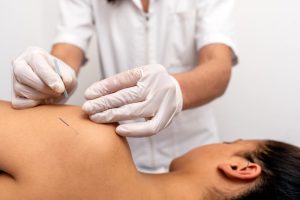 zenuwpijn dry needling