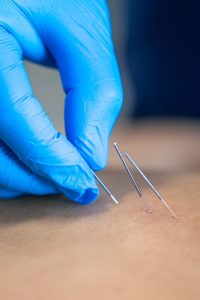 dry needling bijwerkingen